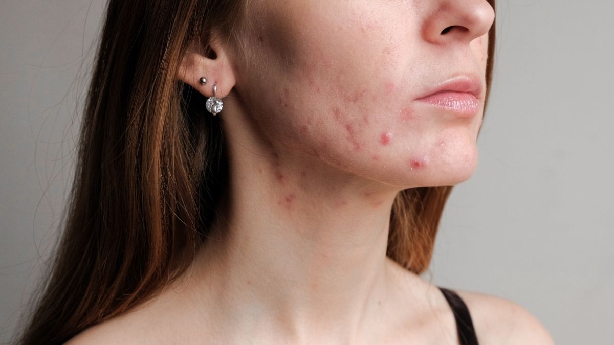 the worst food for skin